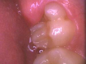 kids teeth issues