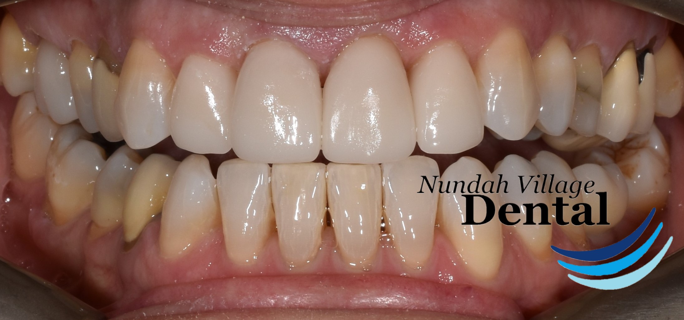 Replacing Old Metal Crowns with Tooth Coloured Ceramic